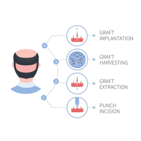 Hair Transplant Deposit